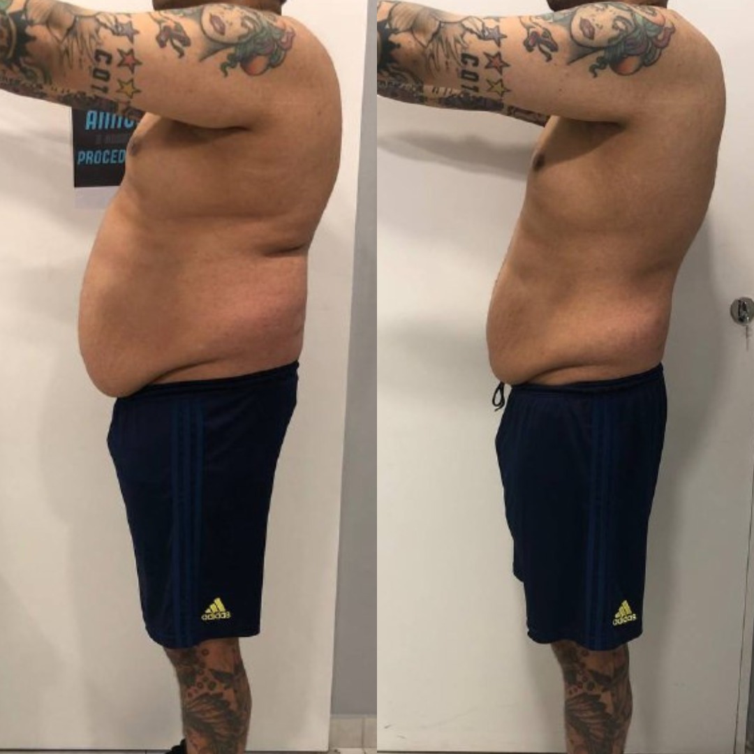 Antes e depois — redução de gordura abdominal
