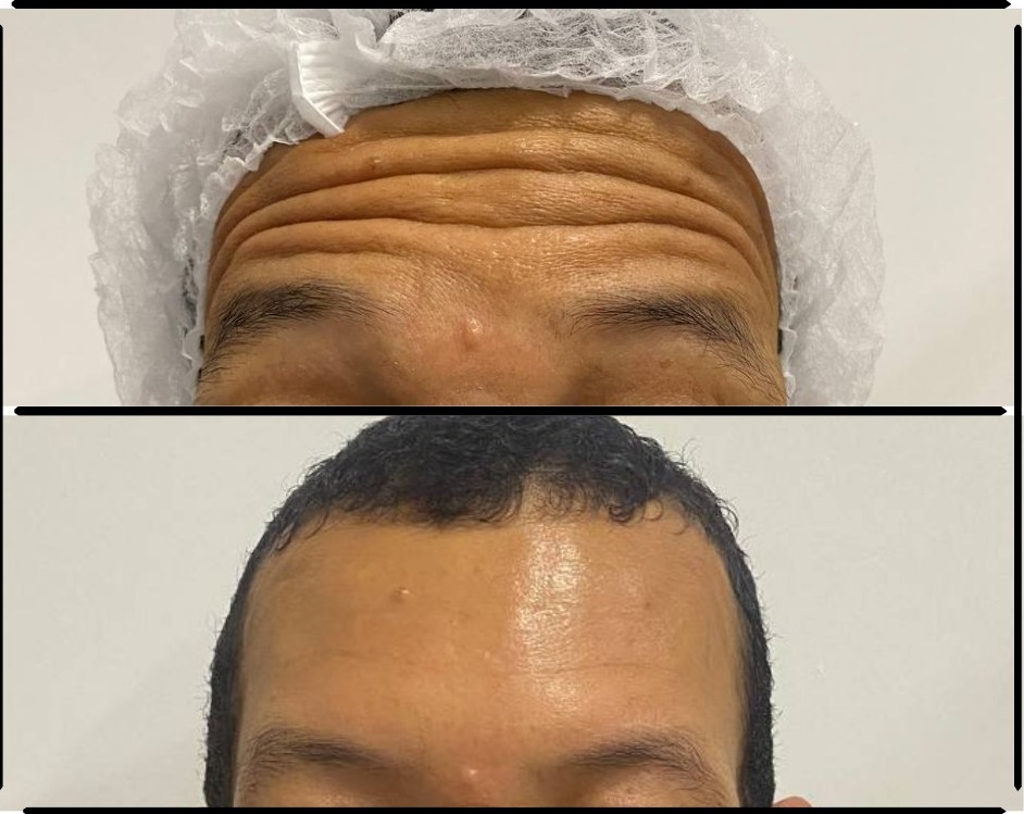 Antes e depois — botox no terço superior