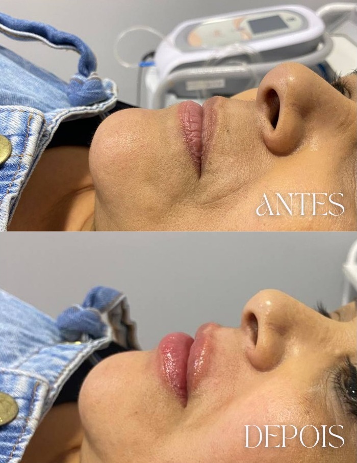 Antes e depois — preenchimento labial
